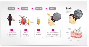 Platelet rich plasma explanation