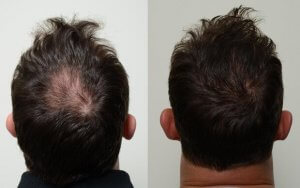 before and after hair transplant photo
