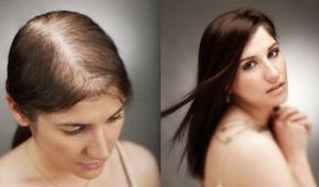 hair transplant women