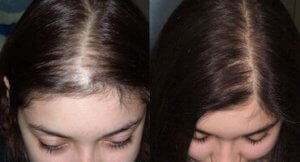 before after female hair transplant