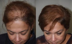 before after female hair transplant