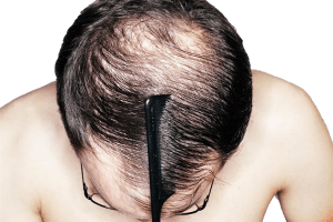 fue hair transplant men